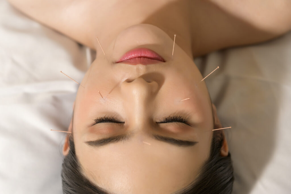 facial acupuncture