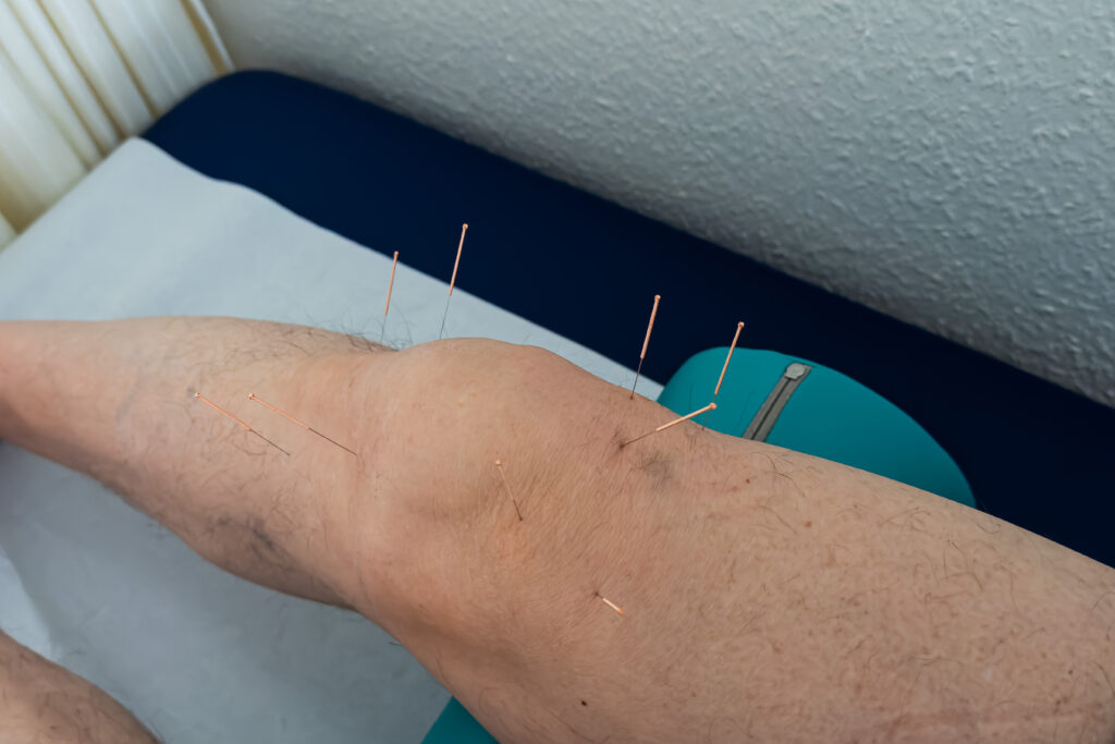 A patient is receiving acupuncture treatment on their knee, with multiple needles inserted for pain relief. The setting is a therapeutic environment focused on wellness.